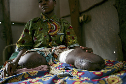 Landmine Victim in Democratic Republic of the Congo